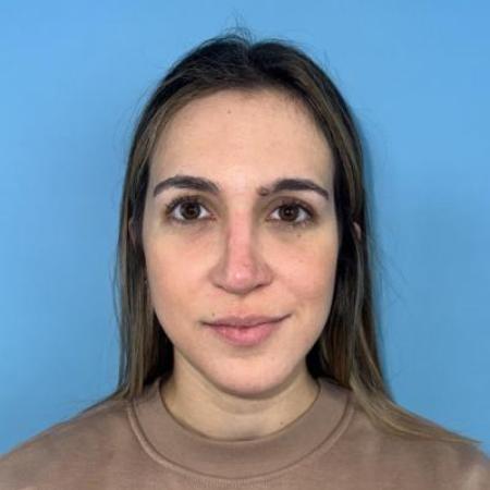 After image 3 Case #114356 - Smiling 6 months after Rhinoplasty