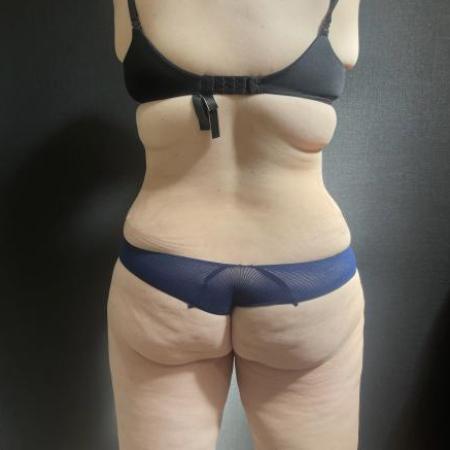 After image 3 Case #114191 - Abdominoplasty with Liposuction of Chest & Flanks