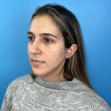 Before image 2 Case #114356 - Smiling 6 months after Rhinoplasty