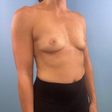Before image 4 Case #114681 - Breast Implants plus a little extra...