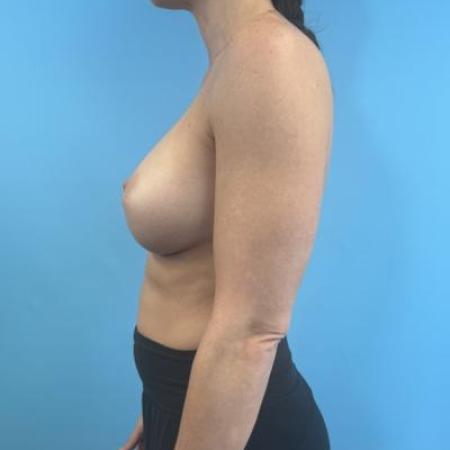 After image 3 Case #114681 - Breast Implants plus a little extra...