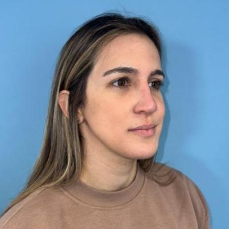 After image 5 Case #114356 - Smiling 6 months after Rhinoplasty