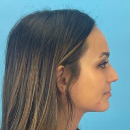 After Case #114396 - Dream nose at 3 months