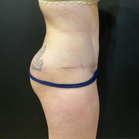 After image 3 Case #114466 - Abdominoplasty with Liposuction and Fat Transfer