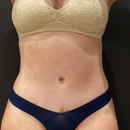 After image 1 Case #114466 - Abdominoplasty with Liposuction and Fat Transfer