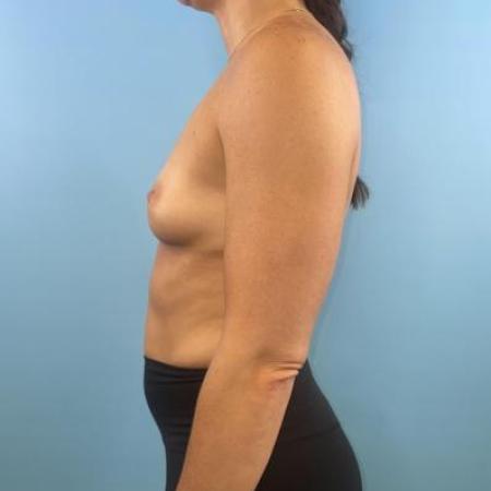 Before image 3 Case #114681 - Breast Implants plus a little extra...