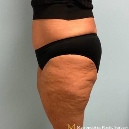 After image 3 Case #112281 - Abdominoplasty