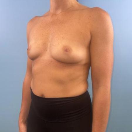 Before image 2 Case #114681 - Breast Implants plus a little extra...