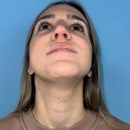 After image 4 Case #114356 - Smiling 6 months after Rhinoplasty