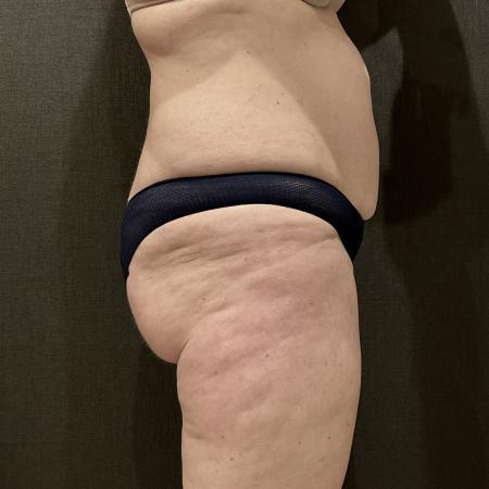 Before image 3 Case #114466 - Abdominoplasty with Liposuction and Fat Transfer
