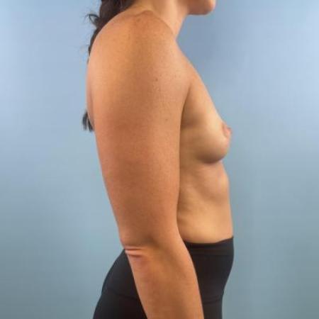 Before image 5 Case #114681 - Breast Implants plus a little extra...