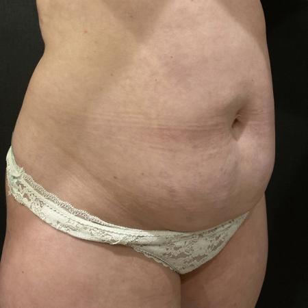 Before image 2 Case #114466 - Abdominoplasty with Liposuction and Fat Transfer