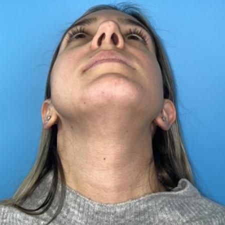 Before image 4 Case #114356 - Smiling 6 months after Rhinoplasty