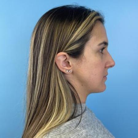 Before image 6 Case #114356 - Smiling 6 months after Rhinoplasty