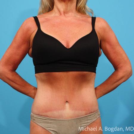 After image 1 Case #115361 - Tummy Tuck