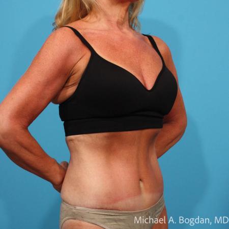After image 2 Case #115361 - Tummy Tuck After image 2 Case #115361 - Tummy Tuck