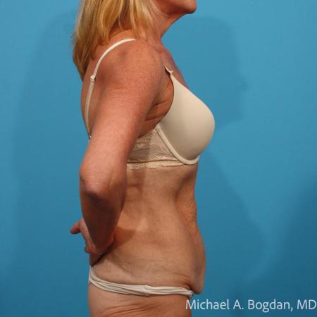 Before image 3 Case #115361 - Tummy Tuck