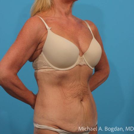 Before image 2 Case #115361 - Tummy Tuck