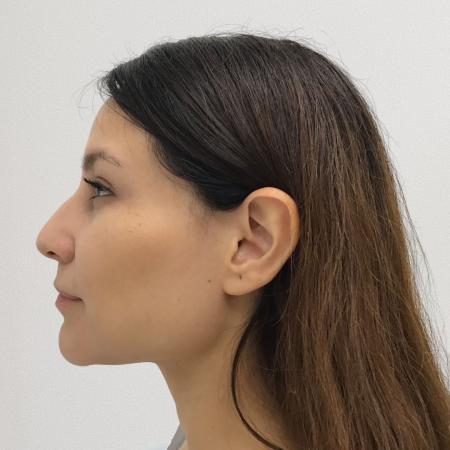 Before image 3 Case #115116 - Rhinoplasty surgery 