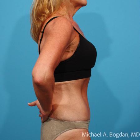 After image 3 Case #115361 - Tummy Tuck