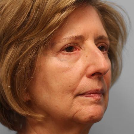 After image 2 Case #115706 - Upper & Lower Blepharoplasty