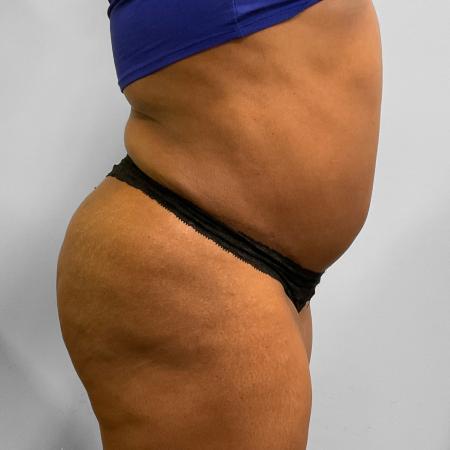 After image 3 Case #115711 - BBL, Tummy Tuck, & Liposuction