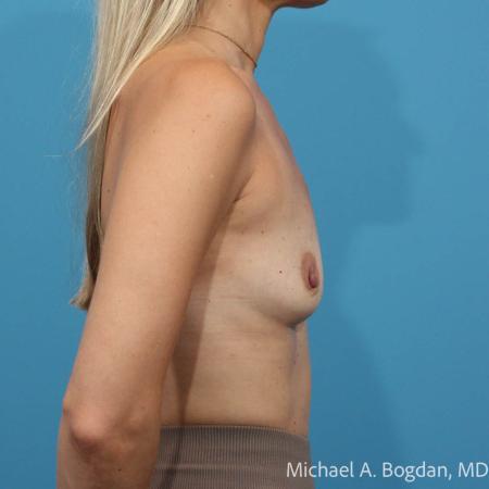 Before image 3 Case #115531 - Breast Augmentation