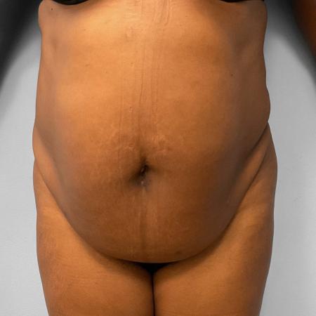 Before image 1 Case #115711 - BBL, Tummy Tuck, & Liposuction