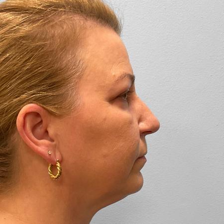 After image 3 Case #115721 - Upper & Lower Blepharoplasty