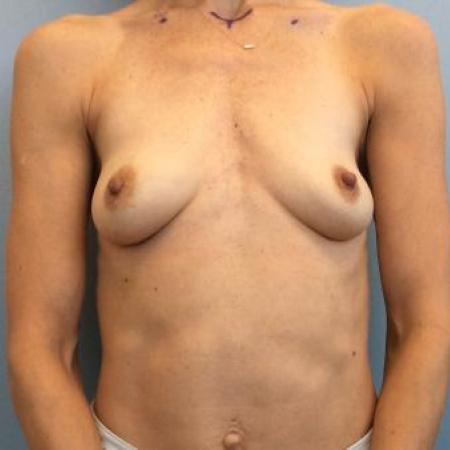 Before image 1 Case #115841 - Breast Augmentation