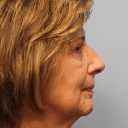 After image 3 Case #115706 - Upper & Lower Blepharoplasty