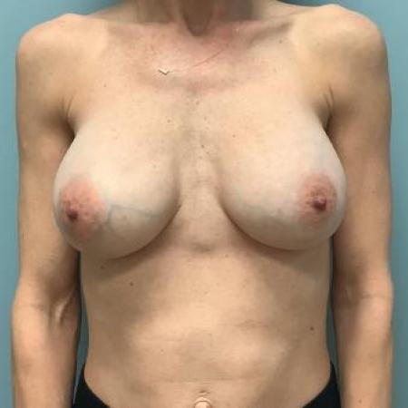 After image 1 Case #115841 - Breast Augmentation