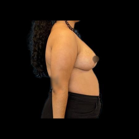 After image 3 Case #115991 - Reduction Mamoplasty 