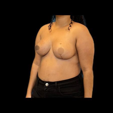 After image 2 Case #115991 - Reduction Mamoplasty 