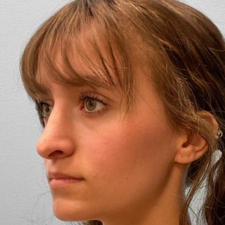 After image 2 Case #115731 - Rhinoplasty