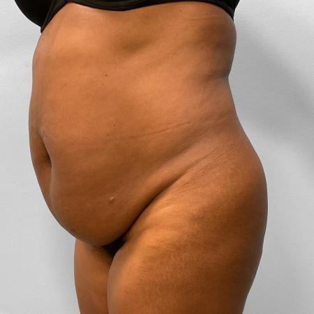 Before image 2 Case #115711 - BBL, Tummy Tuck, & Liposuction