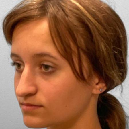 Before image 2 Case #115731 - Rhinoplasty