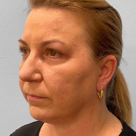 After image 2 Case #115721 - Upper & Lower Blepharoplasty