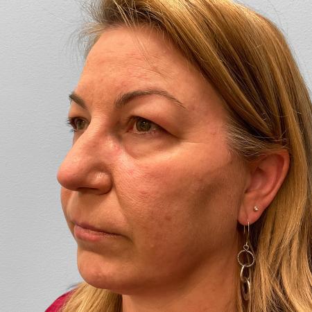 Before image 2 Case #115721 - Upper & Lower Blepharoplasty