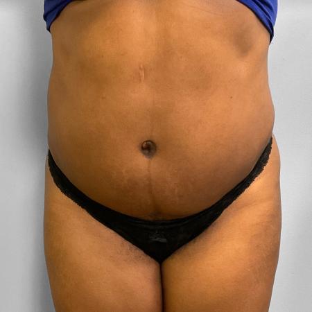 After image 1 Case #115711 - BBL, Tummy Tuck, & Liposuction