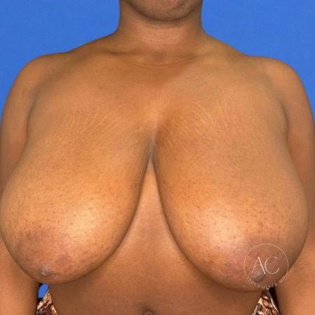 Before image 1 Case #115461 - Reduction mammoplasty