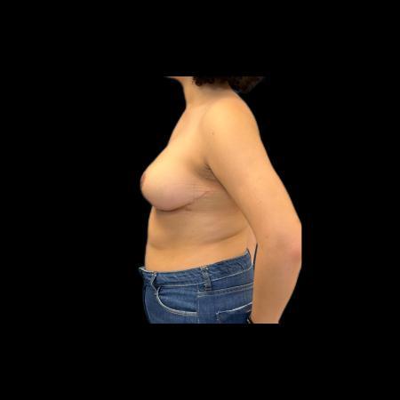 After image 3 Case #115996 - Mastopexy without Implants 