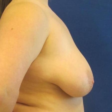 Before image 3 Case #116806 - 22 year-old patient | Breast Reduction