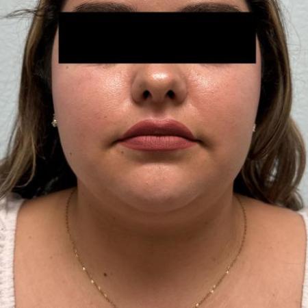 Before image 1 Case #116096 - Submental neck liposuction