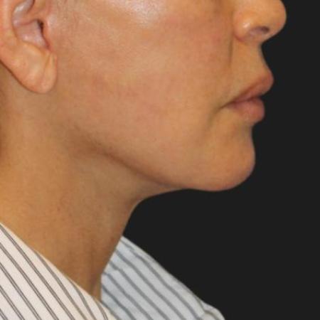 After image 3 Case #116241 - 55 year old patient | Facial Rejuvenation