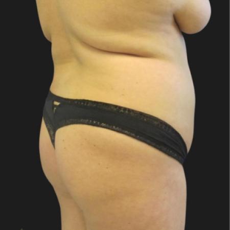 Before image 2 Case #116651 - 23 year-old patient | Liposuction