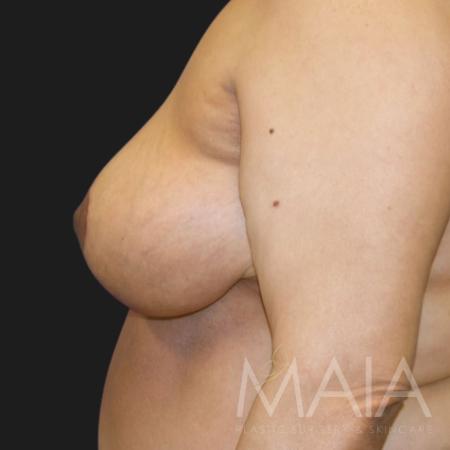 After image 3 Case #116816 - 55 year-old patient | Breast Reduction