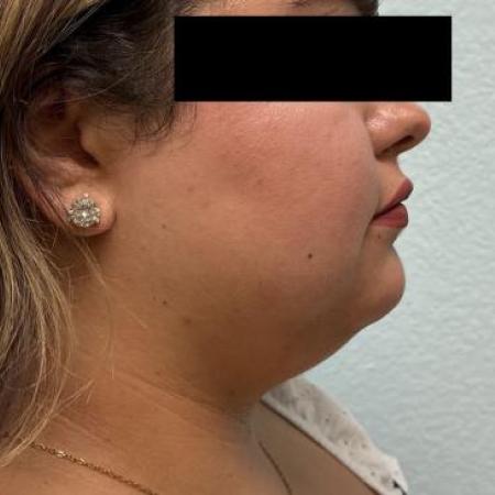 Before image 3 Case #116096 - Submental neck liposuction