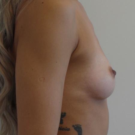 Before image 5 Case #116781 - 32 year-old patient | Breast Augmentation