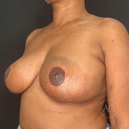 After image 2 Case #116406 - Breast Reduction 